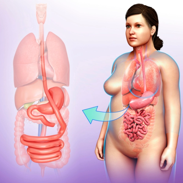 /gastric-bypass/