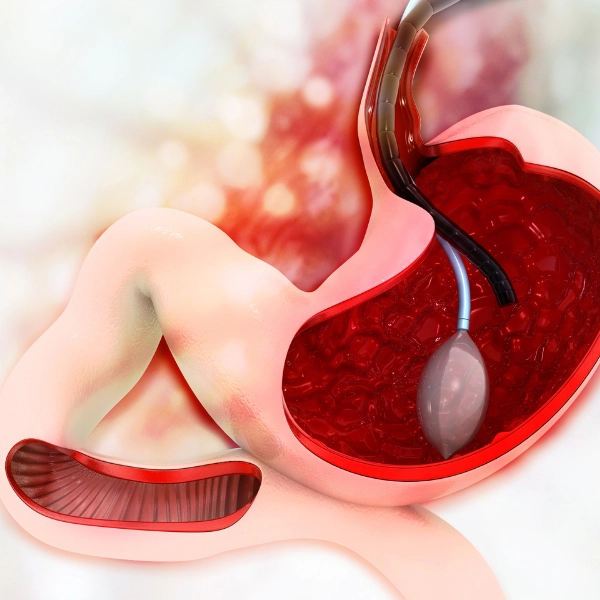 /gastric-sleeve/